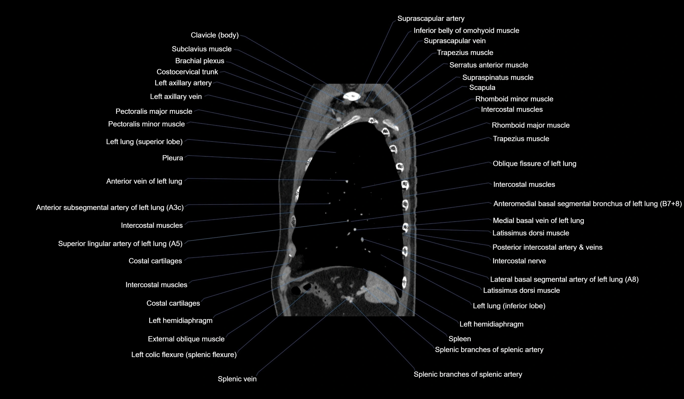 CT chest (thorax) soft tissue window labelled sagittal cross sectional anatomy radiology image-00109.webp